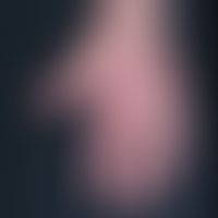 Dermatomyositis (V-Zeichen): Charakteristische, die Diagnose "Kollagenose" nahezu beweisende, kut...