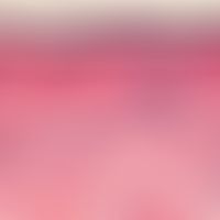 Dermatomyositis. Interface-Dermatitis, Orthokeratose, deutliche Atrophie des Epithels. Retikuläre...