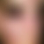 Dermatomyositis. Beginnender, poikilodermischer Zustand der Haut mit Hypopigmentierung, Teleangie...