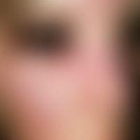 Dermatomyositis. Beginnender, poikilodermischer Zustand der Haut mit Hypopigmentierung, Teleangie...