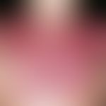 Dermatomyositis. Rot-violettes, gelegentlich juckendes, flächiges&nbsp;Erythem im Decolleté und a...