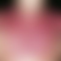 Dermatomyositis. Rot-violettes, gelegentlich juckendes, flächiges&nbsp;Erythem im Decolleté und a...