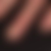 Dermatomyositis: Flat red plaques on the end phalanges. Hyperkeratotic nail folds
