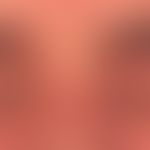 Dermatomyositis: Hautveränderungen der Periorbitalregion.
