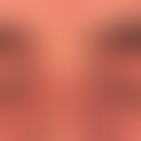Dermatomyositis: Hautveränderungen der Periorbitalregion.
