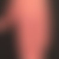 Dermatomyositis (Übersicht):&nbsp; Flächenafte, angedeutet streifes Erythem mit rötlich-lividen P...