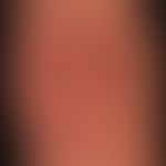 Dermatomyositis
