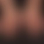 Dermatomyositis (Übersicht):&nbsp; Streifig angeordnet rote Papeln und Plaques, die im Bereich de...
