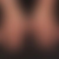 Dermatomyositis (overview): Striped arrangement of red papules and plaques, which confluent to fl...