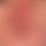 Dermatomyositis: Flächige, unscharf begrenztes, stellenweise zackig auslaufendes&nbsp;rot- livide...