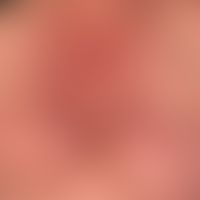 Dermatomyositis: Flächige, unscharf begrenztes, stellenweise zackig auslaufendes&nbsp;rot- livide...