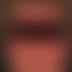 Dermatomyositis. Akut aufgetretenes, diffuses, sukkkulentes Erythem an Gesciht und Decolletee. Al...