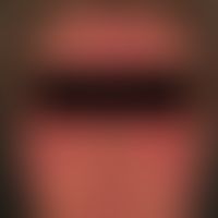 Dermatomyositis. Akut aufgetretenes, diffuses, sukkkulentes Erythem an Gesciht und Decolletee. Al...