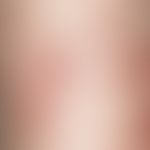 Dermatosis, acute febrile neutrophilic. inflammatory, succulent, livid red papules and plaques in...