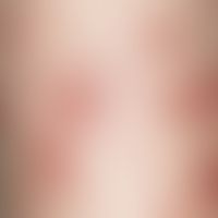 Dermatosis, acute febrile neutrophilic. inflammatory, succulent, livid red papules and plaques in...