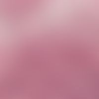 Dermatosis, acute febrile neutrophils; detail enlargement: papillary body edema, dense inflammato...