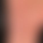 Dermatosis, acute febrile neutrophilic. reddish-livid, succulent, pressure-dolent, infiltrated, s...