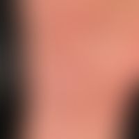 Dermatosis, acute febrile neutrophilic. reddish-livid, succulent, pressure-dolent, infiltrated, s...