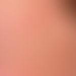 Dermatosis, acute febrile neutrophilic. reddish-livid, succulent, pressure-dolent, infiltrated, s...