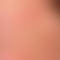 Dermatosis, acute febrile neutrophilic. reddish-livid, succulent, pressure-dolent, infiltrated, s...