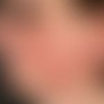 Dermatosis, acute febrile neutrophil. progressive findings in the face of a 45-year-old woman, 4 ...