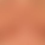 Dermatosis, acute febrile neutrophils. following high fever at the décolleté and breast region of...
