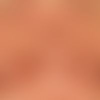 Dermatosis, acute febrile neutrophils. following high fever at the décolleté and breast region of...