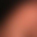 Dermatosis, acute febrile neutrophils (Sweet Syndrome): suddenly appearing inflammatory, succulen...