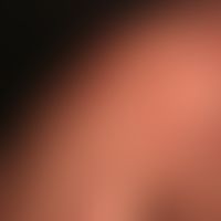 Dermatosis, acute febrile neutrophils (Sweet Syndrome): suddenly appearing inflammatory, succulen...