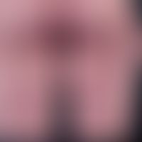 Dermatosis, IgA-lineare. for several years intermittent clinical picture with multiple, considera...