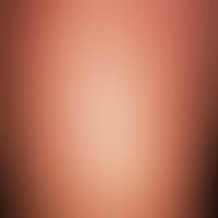 Dermographism albus. pale, whitish striations in the area of scratch marks on the forearm in a 28...