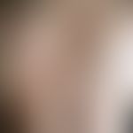 Dermographism, urticarial. urticae formed after the action of shear forces and limited to the sit...