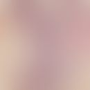 Dilated pore. Zystische Erweiterung des Infundibulums, bei deutlicher Akanthose des Follikelepith...