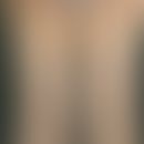 Dodd-Venen. Insuffizienz der Dodd-Perforansvene mit deutlicher Vorwölbung der Varizen im Bereich ...