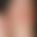 Dorsal salt cyst, mucoid: reddened soft, clearly above the skin level, bulging, tightly elastic, ...