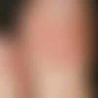 Dorsal salt cyst, mucoid: reddened soft, clearly above the skin level, bulging, tightly elastic, ...
