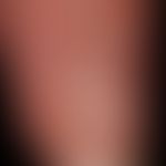 Dorsal cyst, mucoid: dorsal cyst existing for months. burst a few days before, evacuation of a cl...