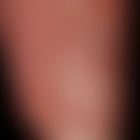 Dorsal cyst, mucoid: dorsal cyst existing for months. burst a few days before, evacuation of a cl...