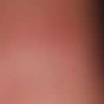 Dorsal cyst, mucoid: Condition following evacuation of a gelatinous fluid; small central ulcer co...