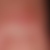 Dorsal cyst, mucoid: Condition following evacuation of a gelatinous fluid; small central ulcer co...