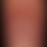 Dorsal cyst, mucoid: painless, approximately 1.0 cm large, skin-coloured, plumply elastic, surfac...