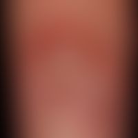 Dorsal cyst, mucoid: painless, approximately 1.0 cm large, skin-coloured, plumply elastic, surfac...