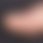 Dyshidrosis: Multiple, acutely occurring, skin-coloured, isolated but also aggregated, smooth, it...