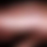 Dyshidrosis lamellosa sicca. 32-jährige Patientin mit rezidivierend auftretenden Eruptionen feins...