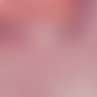 Dyskeratosis: On the left side of the picture dyskeratotic cells (corps ronds) are visible on the...