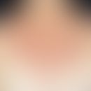 Dyskeratosis follicularis: densely packed brown-reddish papules, about 2-4 mm in size, which aggr...