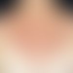 Dyskeratosis follicularis: dicht stehende, etwa 2-4 mm große, braun-rötliche Papeln, die im Dekol...