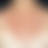 Dyskeratosis follicularis: densely packed brown-reddish papules, about 2-4 mm in size, which aggr...