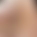Dyskeratosis follicularis. Befall der Handflächen. In zentralen Bereichen des Handtellers flächen...