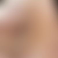 Dyskeratosis follicularis: Infestation of the palms of the hands; in central areas of the palm fl...